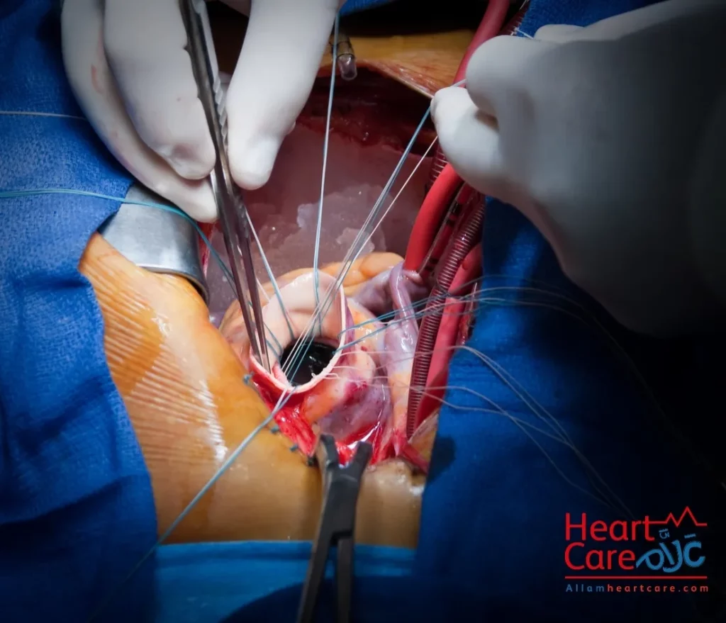 خطورة امراض صمامات القلب | العلاج الجراحي 
