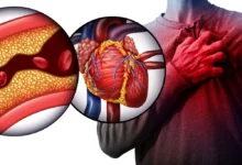 كيفية التعامل مع الجلطة القلبية