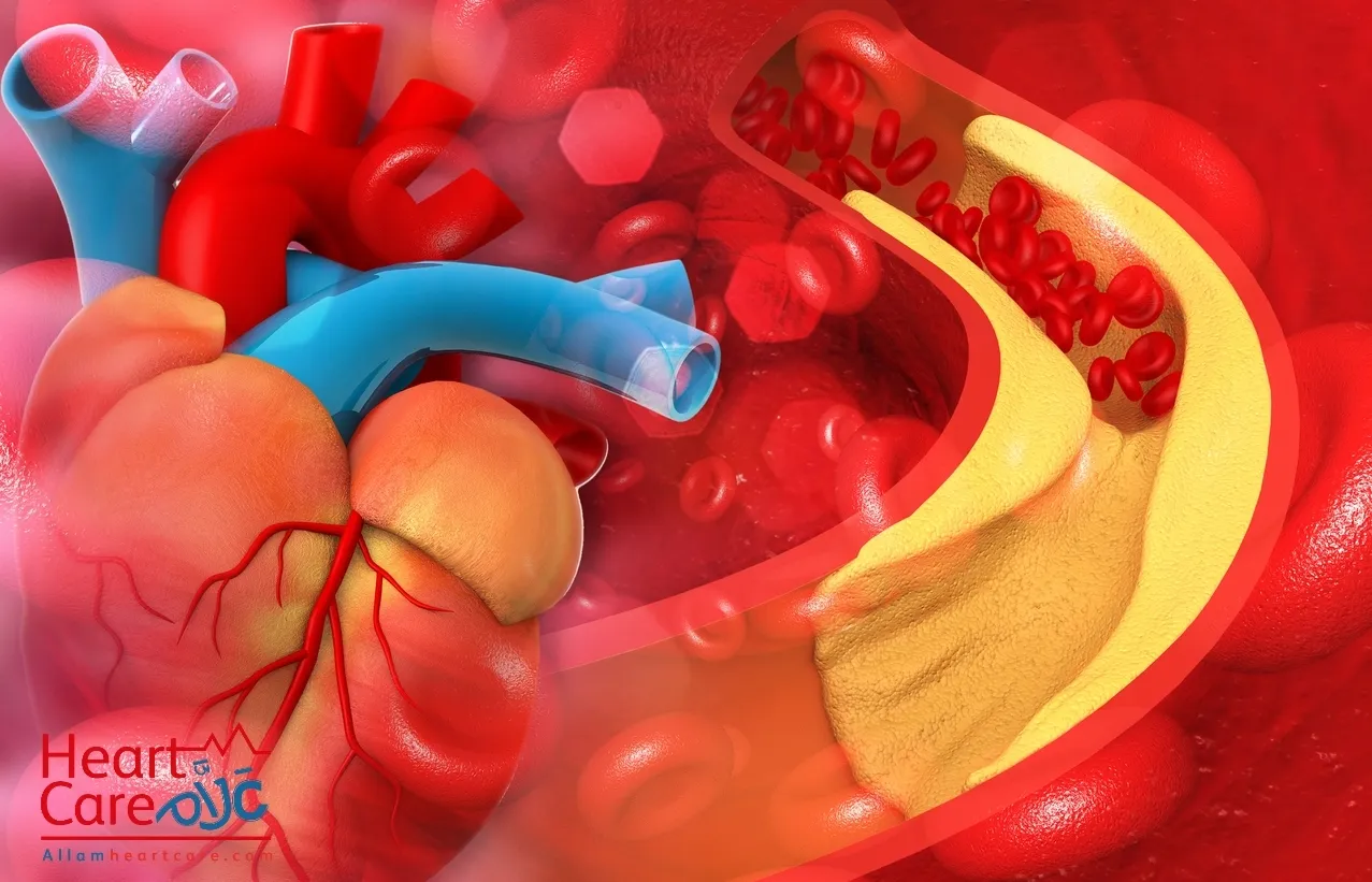 علاج قصور الشريان التاجي بدون جراحة - علّام لصحة القلب